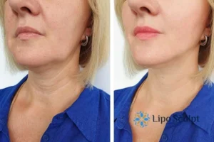 Double chin before and after Hi-Fu treatment 4 Book your double chin treatment Beaumont Leys today! We are here to help!