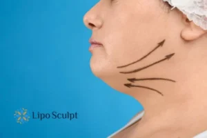Double chin before and after Hi-Fu treatment 3 Boost your confidence with a Double chin treatment Beaumont Leys
