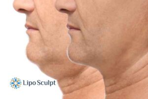 Double chin before and after Hi-Fu treatment 2 Double chin treatment Beaumont Leys from Lipo Sculpt - feel more confident today!
