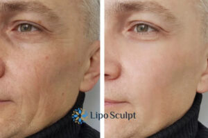 How to Fight Aging Symptoms 3 Fight Aging Symptoms Beaumont Leys With HIFU and Morpheus8 Today!