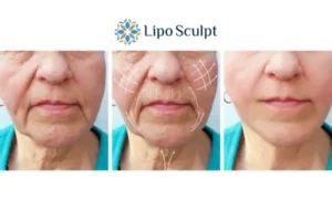 Explaining Morpheus8 And What It Can Do For You 3 Boost your confidence with Morpheus8 Beaumont Leys call our team today!
