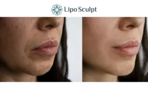 Explaining Morpheus8 And What It Can Do For You 4 Morpheus8 Beaumont Leys the best results - call our team today!