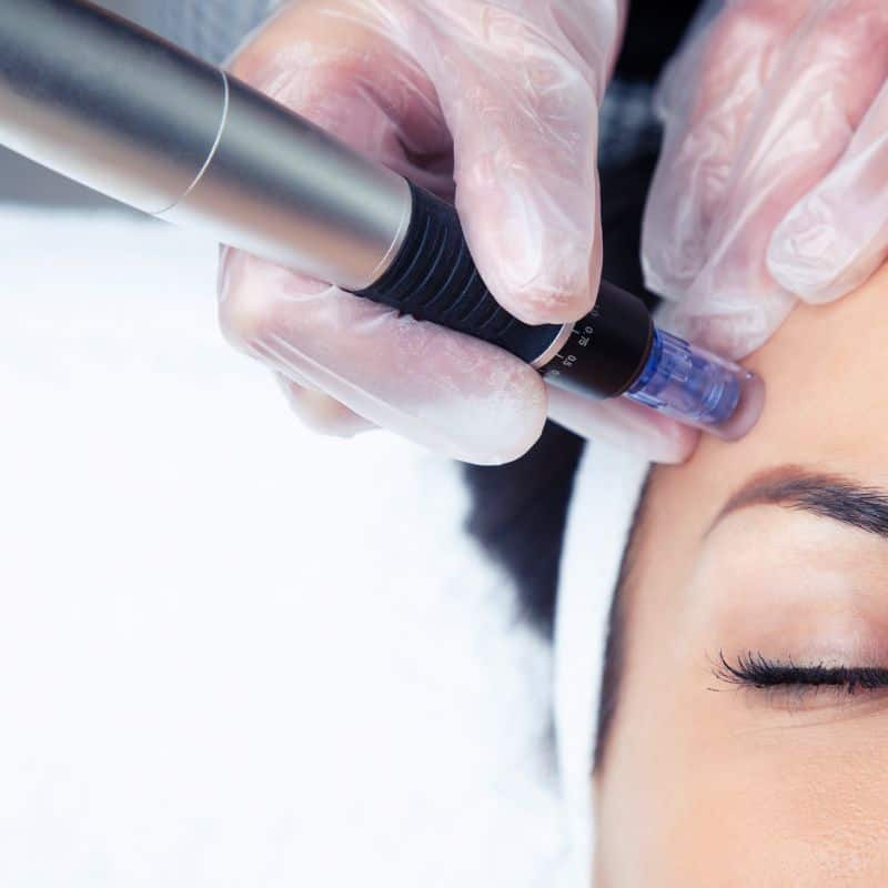 Morpheus8 treatment Beaumont Leys from Lipo Sculpt - Book in today!